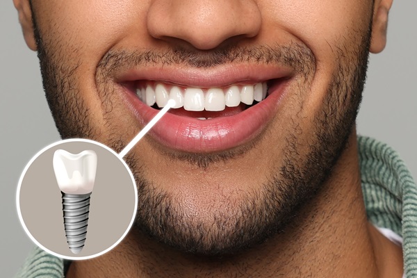 Dental Implant To Replace Single Missing Tooth