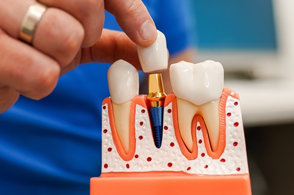 Dental Implants Step By Step: Procedure And Recovery