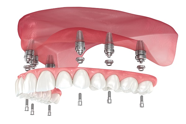 What Are Full Mouth Dental Implants?