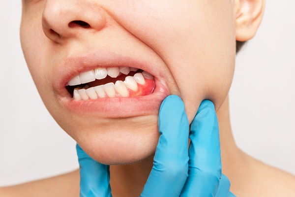 Common Signs Of Gum Disease